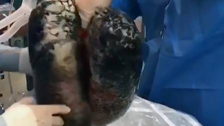 Shocking Video Shows Lungs Blackened After Decades Of Smoking 