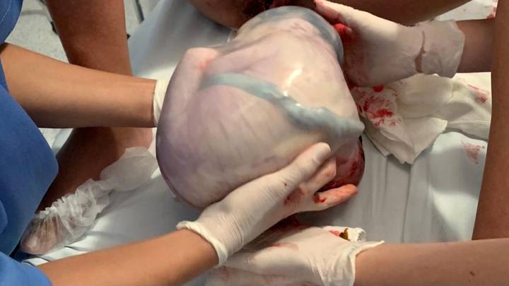 Twin Baby Born In Amniotic Sac In Extremely Rare Birth