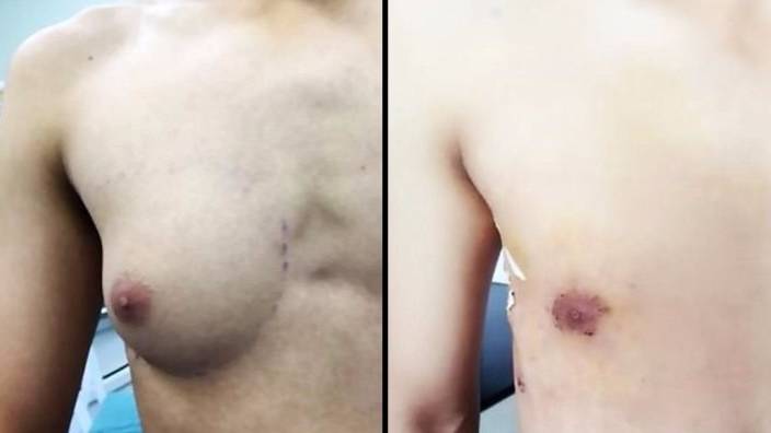 Teenage Boy Undergoes Surgery To Get Rid Of A-Cup Breast - LADbible