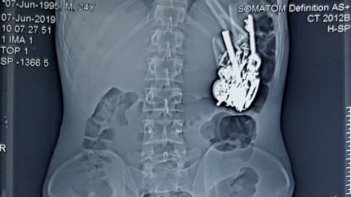 Doctors Remove Knives, Keys And Coins From Man's Stomach