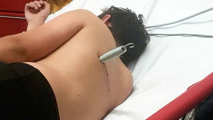 Boy Left With Metal Spring Embedded In His Back After Shocking Trampoline Accident 