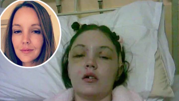 Woman Who Lost Her Forehead In Crash Urges People: 'Learn From My Mistake'