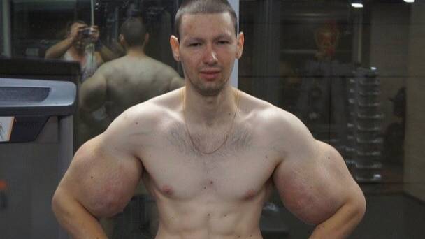 'Russian Popeye' Undergoes Surgery To Remove Petroleum Jelly From Fake Biceps