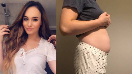 Woman With Endometriosis Is Often Mistaken For Being Pregnant As Bloating Is So Bad