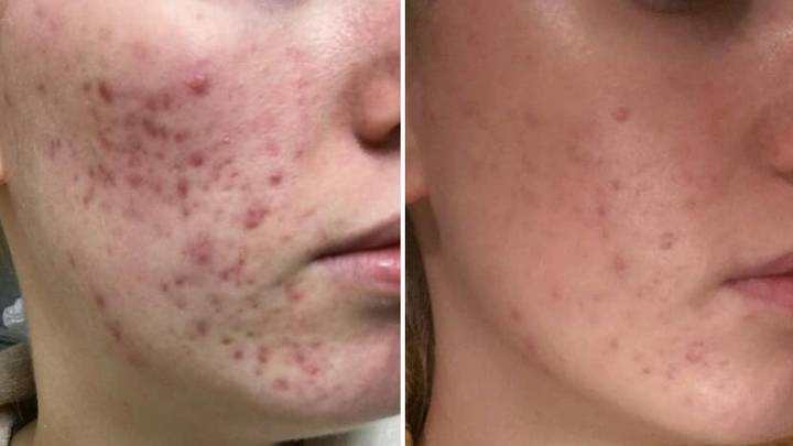 Thousands Of Acne Sufferers Claim This £25 Pill Has Cleared Up Their Bad Skin For Good