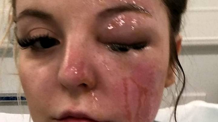 Woman Nearly Blinded And Suffers Horrific Facial Burns After Microwaved Eggs Explode In Her Face