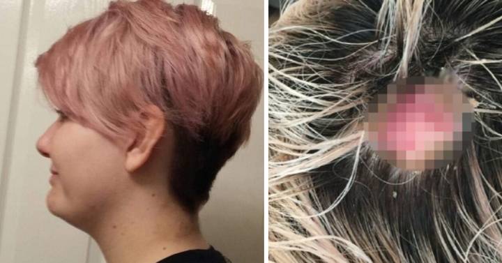 Woman Left With Chemical Burns After Bleaching Her Hair