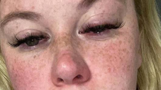 Woman Issues Warning After Zoflora Left Her 'Skin On Fire' And Eyes Swollen