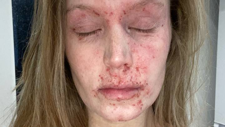 Eczema Sufferer Issues Urgent Warning About The Dangers Of Topical Steroid Use
