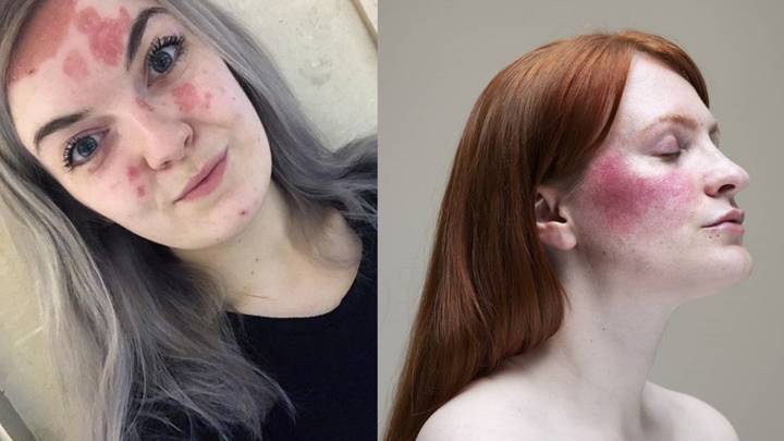 Women Reveal What It’s Like To Live With Extreme Eczema, Rosacea and Psoriasis