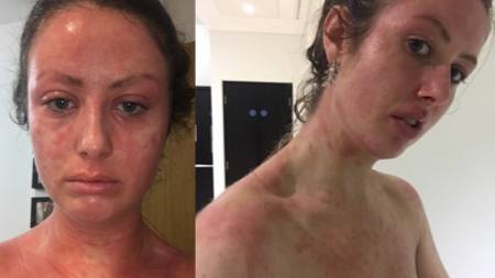 Eczema Suffer Says £15 Coffee Scrub Helped Improve Her 'Life-Limiting' Skin Condition