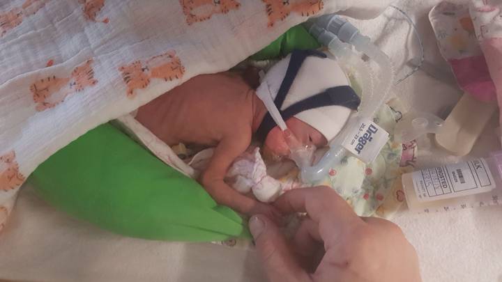 Baby Born With Hands The Size Of 1p Reaches First Birthday