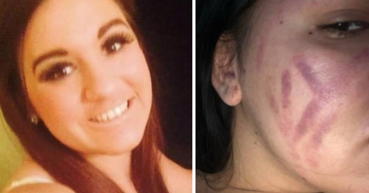 Woman Left With Horrendous Bruises After Using £20 Bellevia Blackhead Vacuum