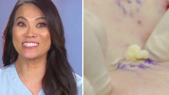 'Dr Pimple Popper' Fans Will Love This Disgusting New Spot Popping Documentary