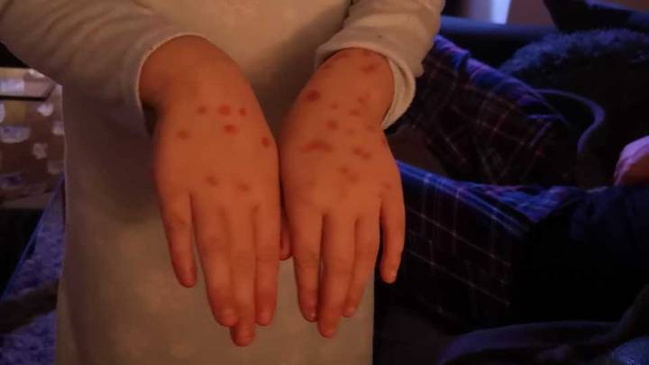 Crafty Young Girl Pretends She Has Chicken Pox To Miss School