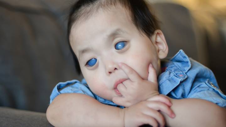 Five Year Old Girl With Rare Silver Eyes Has Them Removed Tyla