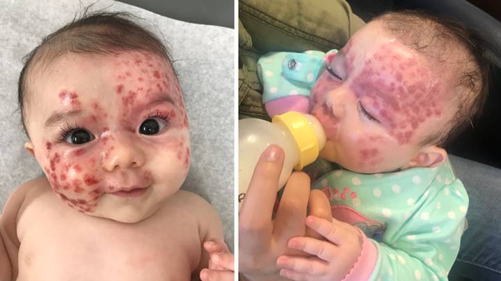 Mum Calls Out Abuse Over Baby Daughter's 'Polka Dot' Birthmark