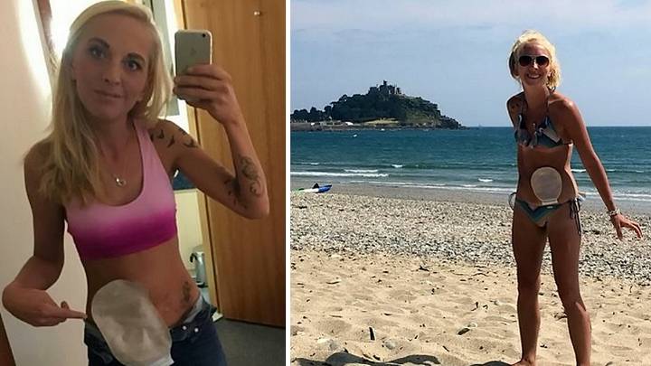 Woman With Stoma Goes On Mission To Prove Colostomy Bags Don't Smell
