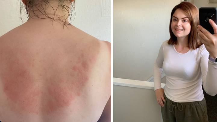 Woman Scared To Leave The House After Developing Sun Allergy That Causes Blisters