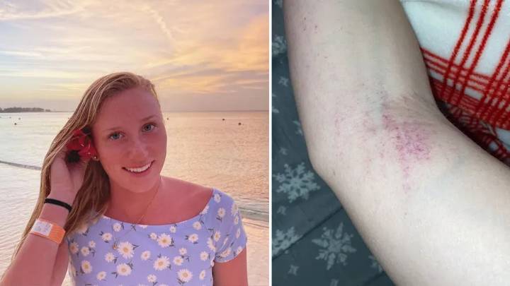Woman's Urgent Warning After 'Tiny Dots' On Arm Turned Out To Be Cancer