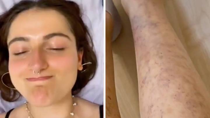 Woman Urges Others Not To Wax Their Legs At Home After 'Traumatising' Fail