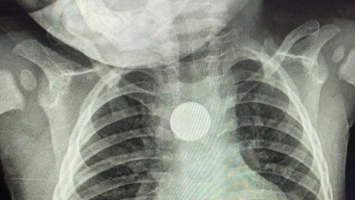 Mum's Urgent Warning After Toddler Is Almost Killed By A Button Battery