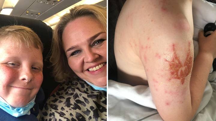 Mum's Warning After Son Suffers Chemical Burn From Henna Tattoo