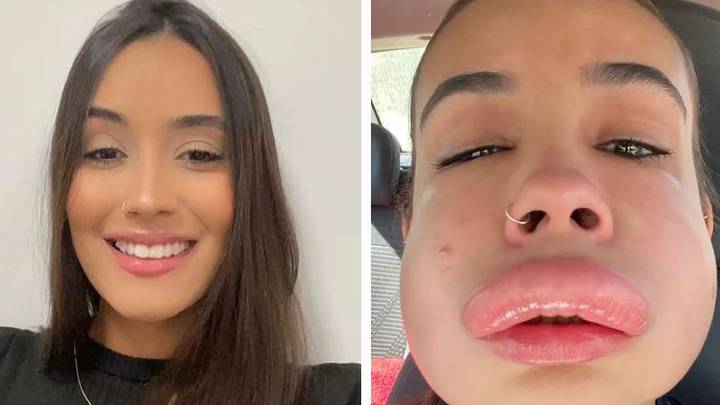 Woman ‘nearly died’ after getting lip filler