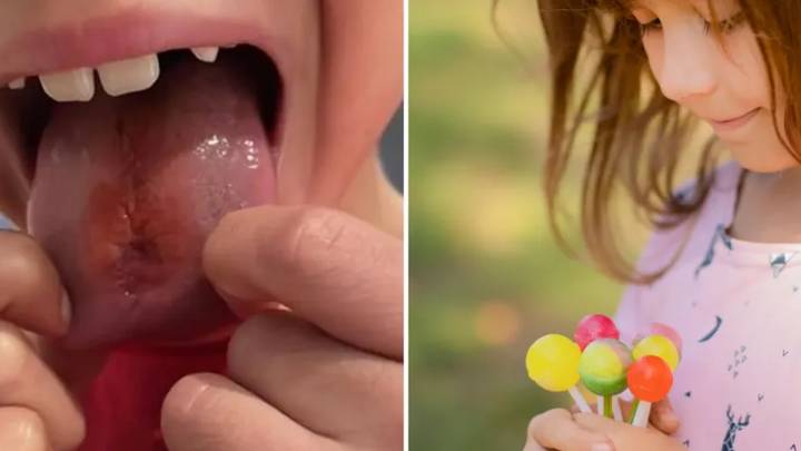 Mum Issue Warnings After Child Burns Tongue On Sour Lollipop