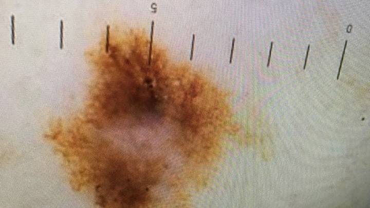 Mum Issues Warning After Discovering Cancerous Mole During Pregnancy