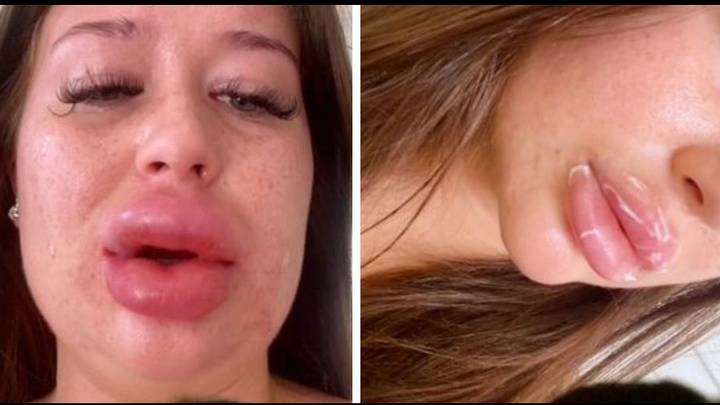 Woman’s warning after dissolving lip filler caused severe reaction