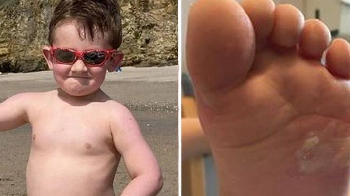 Mum's Plea To Beachgoers After Son's Foot 'Melts Like Wax' On Sand