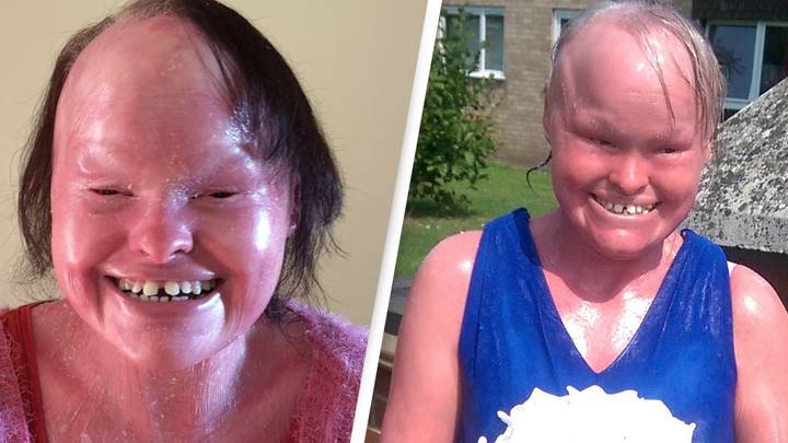 Woman Who Had Rare Condition Where Skin Grew Too Fast Dies Aged 32