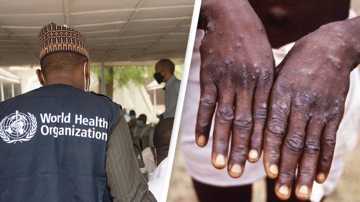 Monkeypox Adds To ‘Formidable’ Challenges To The World, WHO Says
