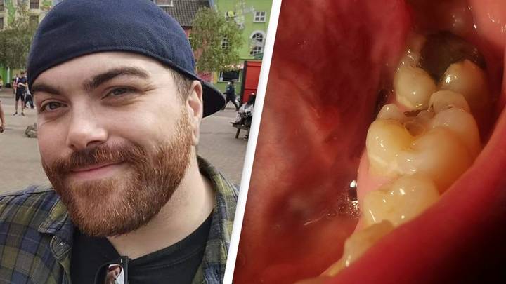 Man Pulls Out Bits Of Teeth With Pliers After Struggling To Find A Dentist