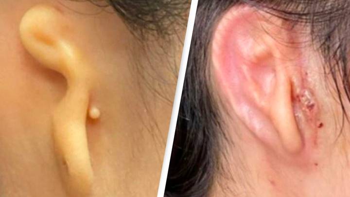 Woman Receives World's First 3D Printed Ear