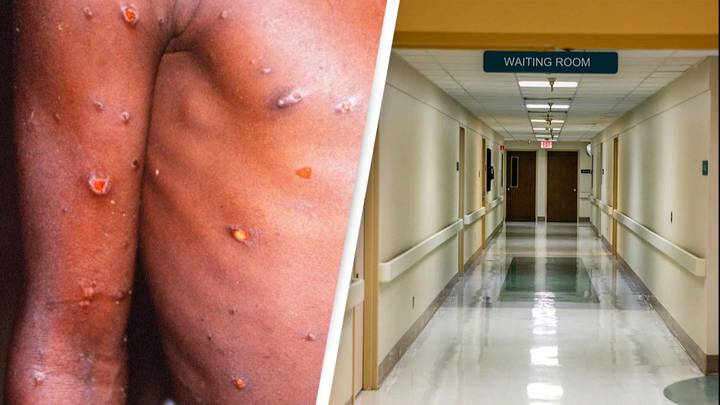 Monkeypox Detected In The US Following Europe Outbreak