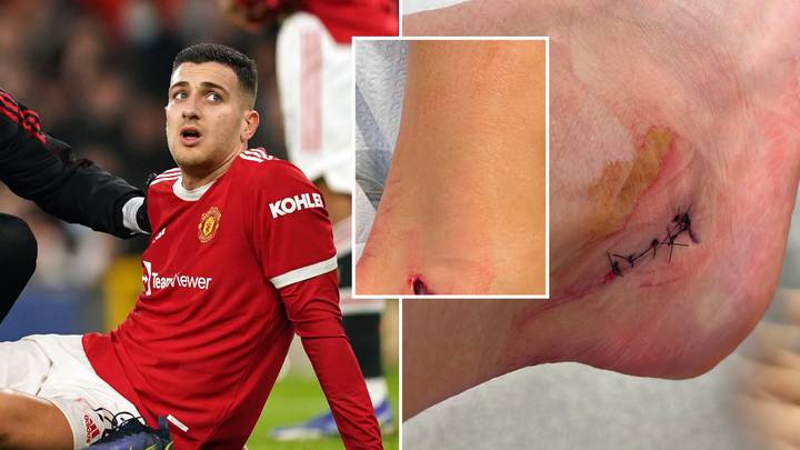 Diogo Dalot's Ankle Injury Was So Gruesome Before Stitches, You Could See His Bone