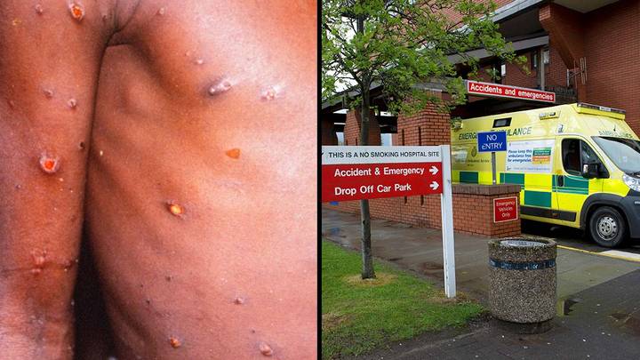More Cases Of Monkeypox Identified In The UK