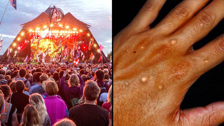 Monkeypox Warning Issued For The Thousands Of People Heading To Glastonbury