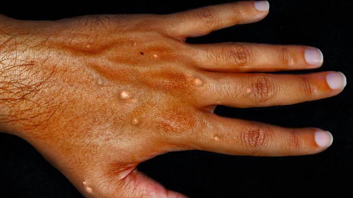 Is The Monkeypox Vaccine Available In Australia? Where Can I Get It?