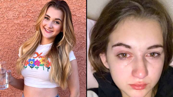 Girl Allergic To Water Can't Cry Or Shower Without Breaking Out In Hives