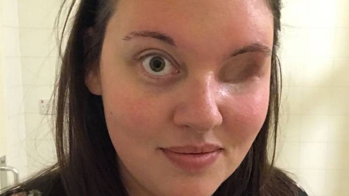 Mum With Rare Form Of Cancer Refuses To Wear A Prosthetic Eye