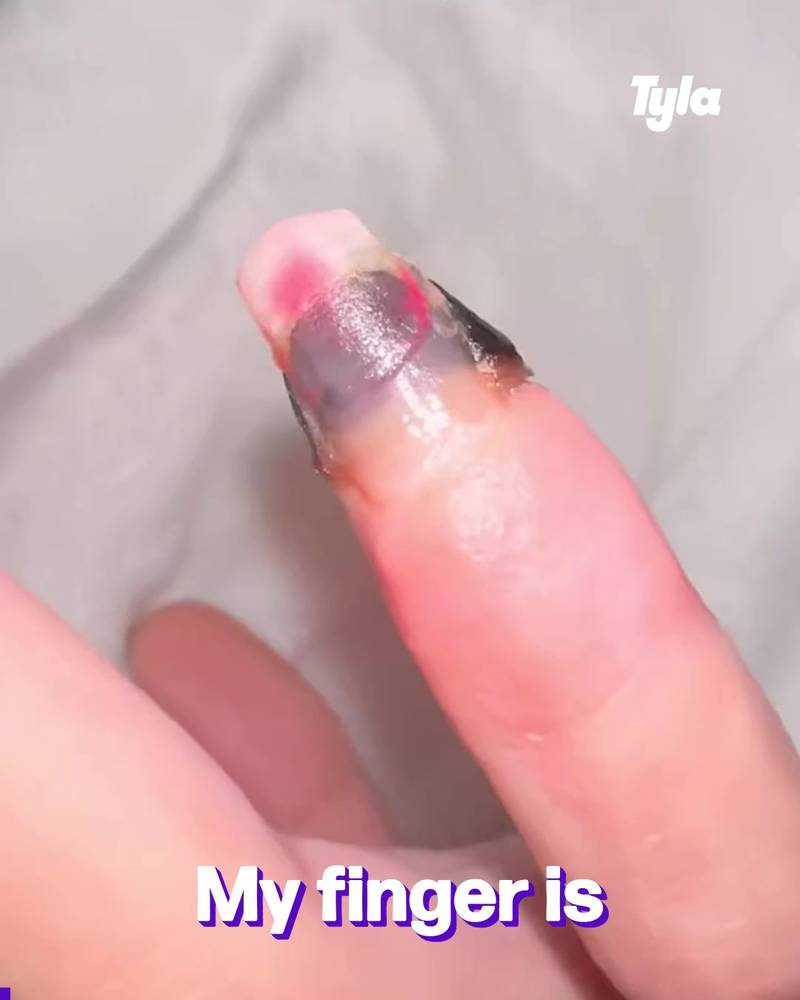 Dead finger story