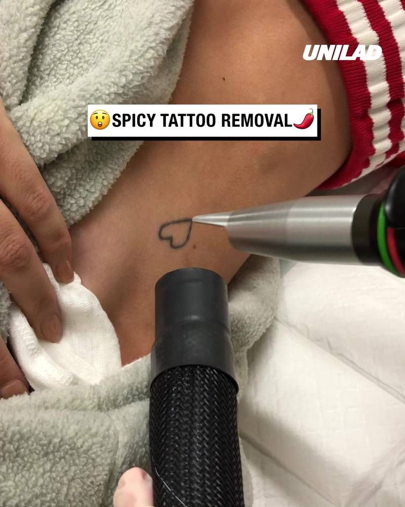 Spicy tattoo removals