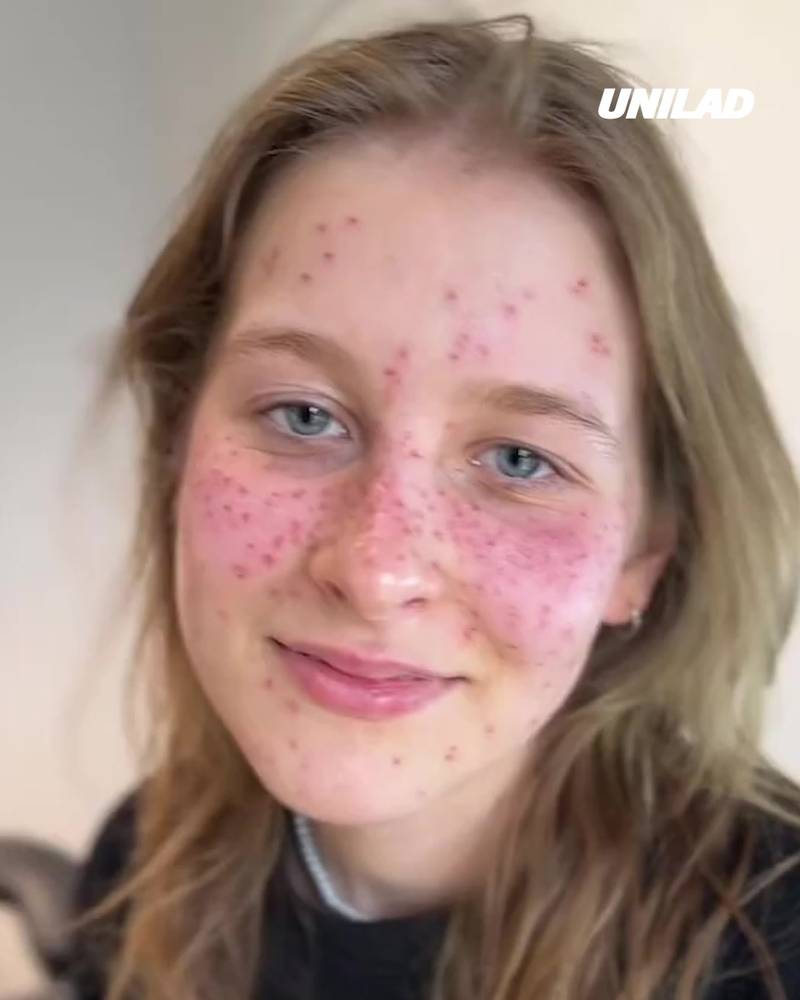 Tattooing freckles on your face