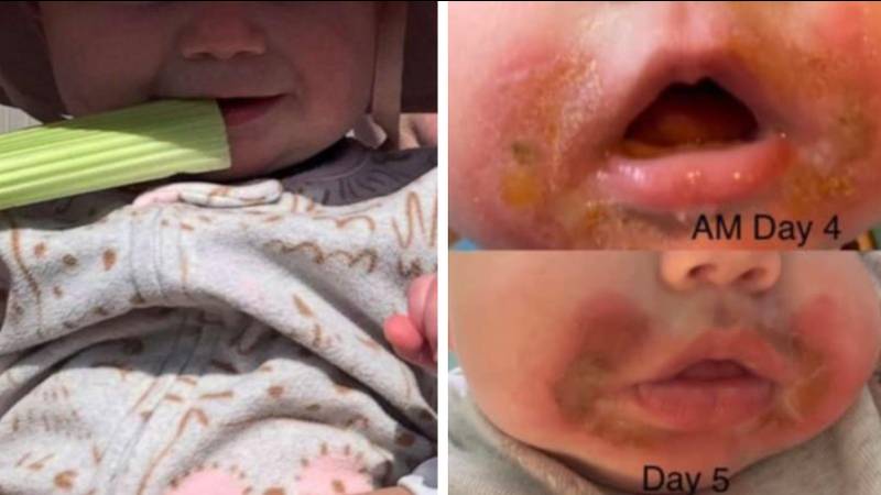 Mum issues warning after baby daughter got ‘margarita burn’ from eating celery