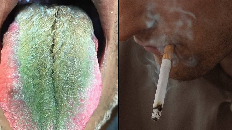 对香烟和抗生素反应后，人的舌头变成绿色和毛茸茸