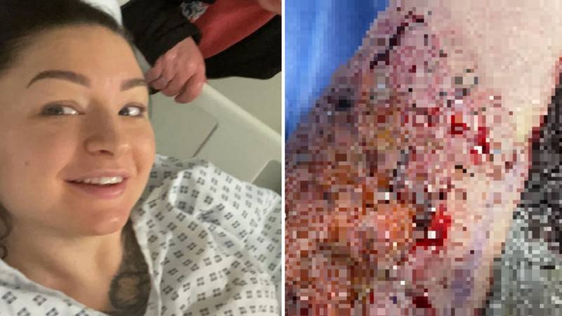 Woman left in a wheelchair for weeks as she suffered third-degree burns after using common period pain relief