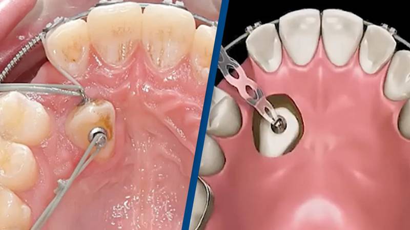 People can't believe how painful 'pulling tooth into place' with braces looks